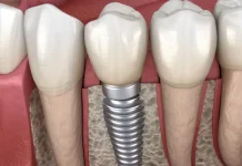 Зубные импланты в Ставрополе: когда здоровье улыбки — в приоритете